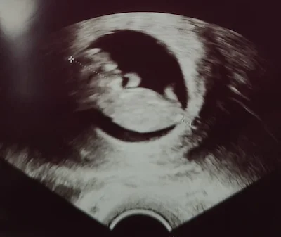 From heartbeat to health checks: Navigating your very first antenatal appointment with confidence.